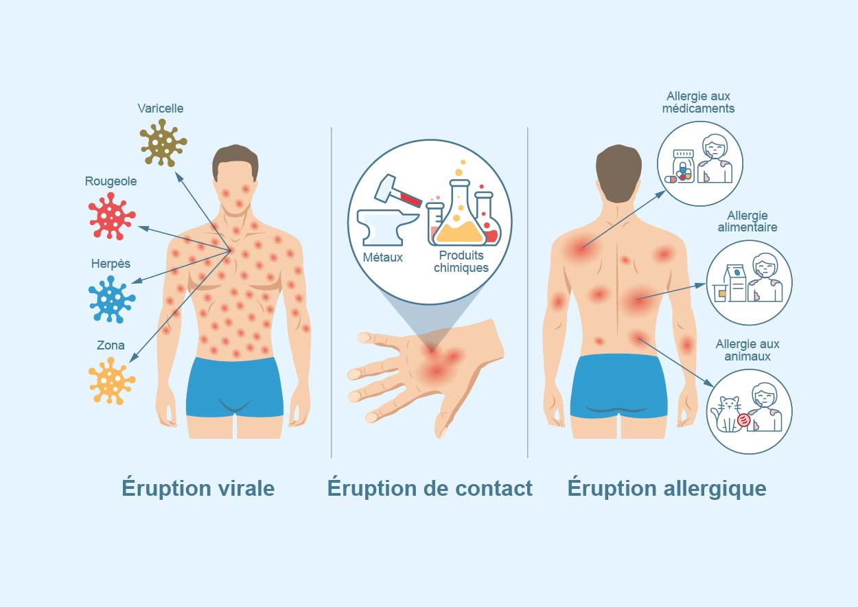Quoi faire en cas d'ruption cutane | Assura