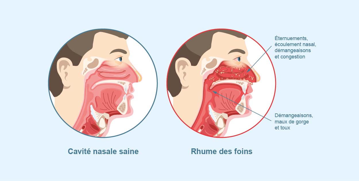 elfbar nachfüll pod läuft aus ACTIFED Rhume - Fièvre, nez bouché et écoulement nasal